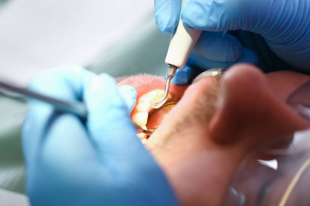 Best Emergency Dentist for Lost Fillings or Crowns in Progreso, TX